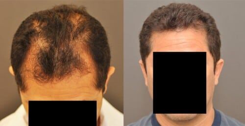 NeoGraft FUE hair transplant before and after
