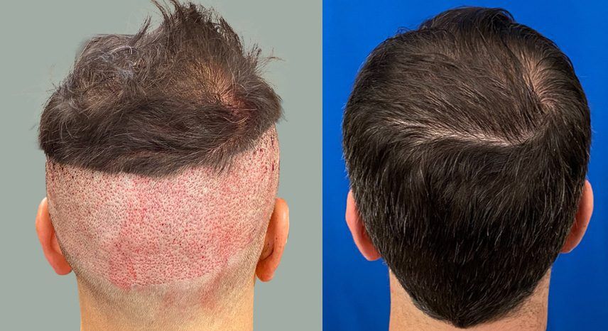 Follicular Hair Restoration Before and After Panel